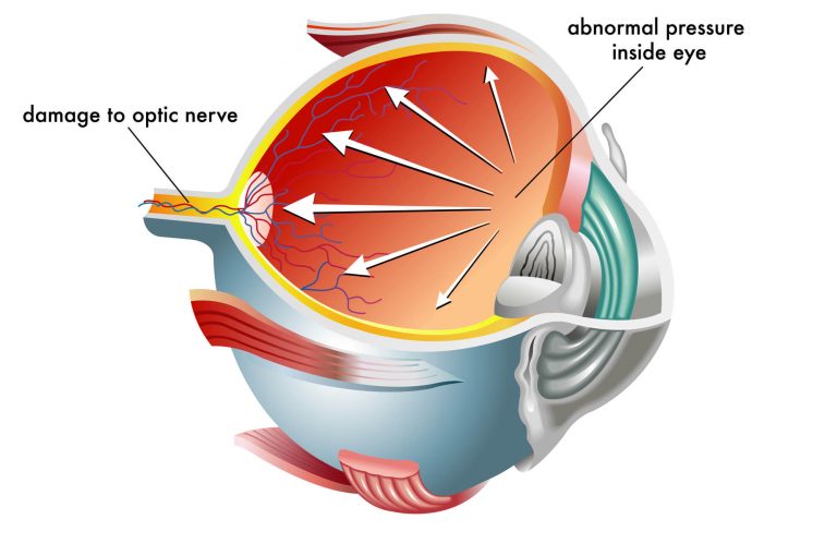 glaucoma o que é
