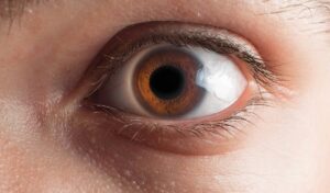 Olhos castanhos claros com a pupila dilatada.